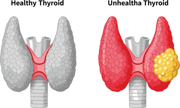Thyroid Gland Comparison Vector with Healthy and Diseased Thyroid, Goiter Condition Medical Anatomy Illustration for Healthcare Education