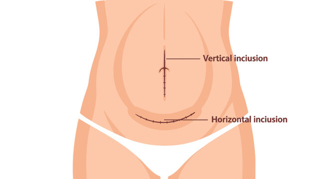 Medical illustration depicting vertical and horizontal cesarean section incisions on a woman's lower abdomen