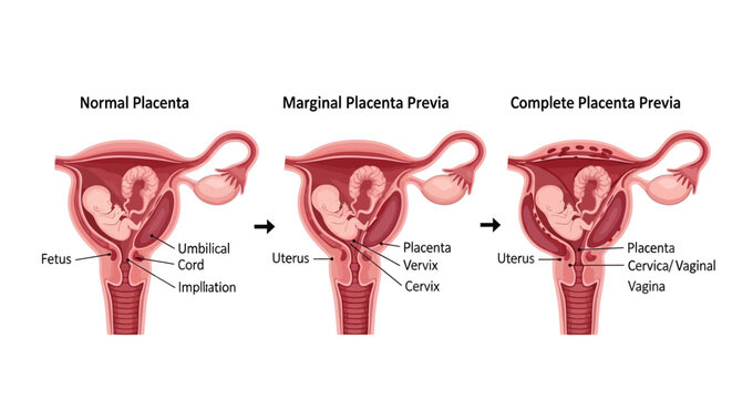 Understanding different types of placenta previa, including normal, marginal, and complete conditions during pregnancy