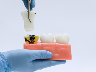 A gloved hand holds a dental model while another hand uses tweezers to lift a removable tooth crown, exposing deep tooth decay and infection in a cross-section model used for dental education.