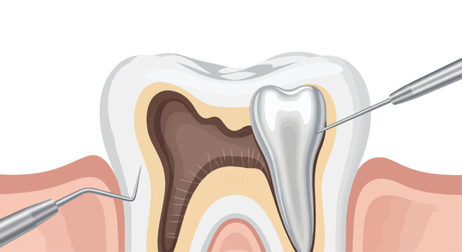 Illustration of a dental filling procedure on a molar tooth with a dental instrument