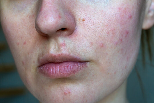 Close up of young woman face with visible acne, redness and uneven skin texture. Concept of skincare, dermatology, cosmetic treatment and skin problems.