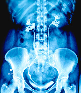 X-ray of human IVU. Right lower ureteric calculus at VUJ with back pressure changes and mild hydroureteronephrosis. Normally excreting both kidneys.