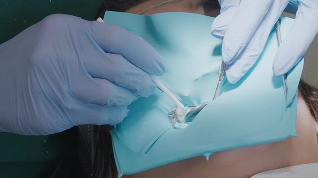 Pediatric dentist uses disposable microbrush applicator to spread blue etching gel over isolated child tooth surface and cavity. Chemical acid preparation before bonding procedure.