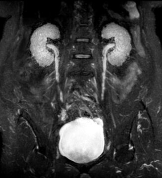 Coronal view magnetic resonance imaging (MRI) of the human abdomen showing healthy kidneys, ureters, urinary bladder, and lumbar spine.