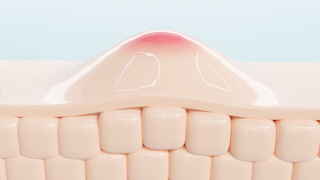 3D Illustration of skin inflammation, acne pimple on skin layers structure. Medical and skincare concept.