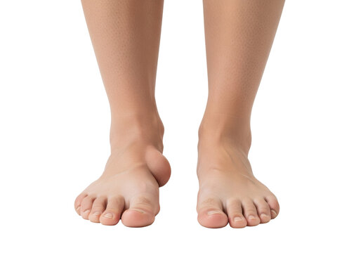 Bare human feet on a white floor, one exhibiting a severe hallux valgus (bunion) deformity contrasted with a normal, healthy foot, detailed anatomical study atmosphere