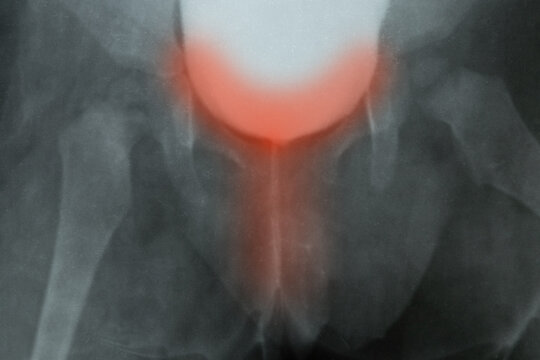 X-ray of a child's pelvis and bladder with contrast for diagnostics, examination of the urinary system