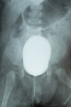 X-ray of a child's pelvis and bladder with contrast for diagnostics, examination of the urinary system