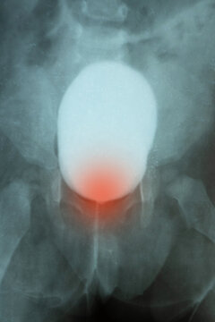 X-ray of a child's pelvis and bladder with contrast for diagnostics, examination of the urinary system