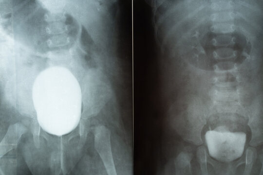 X-ray of a child's pelvis and bladder with contrast for diagnostics, examination of the urinary system