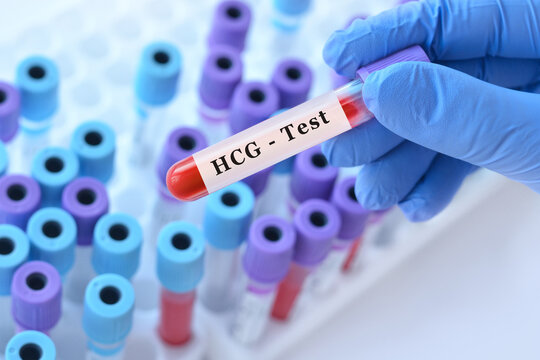 Doctor holding HCG blood test tube explaining pregnancy detection, hormone level measurement and diagnosis of reproductive and gestational conditions in clinical laboratory diagnostics