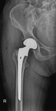 Postoperative Right Hip Replacement X-ray Showing Femoral Prosthesis and Surgical Staples