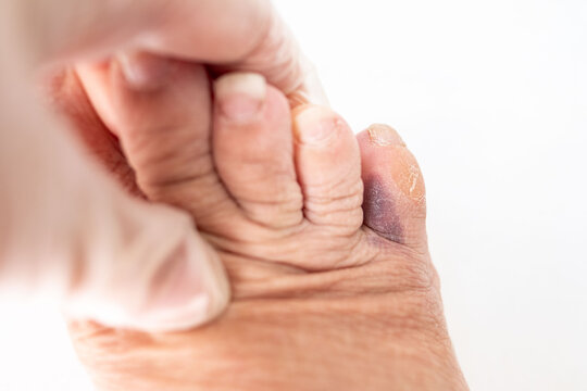 Senior female foot with purple bruise on small toe, orthopedic trauma, swelling, fracture risk, healthcare, accident, medical treatment, toe injury, pain and discomfort from hitting furniture