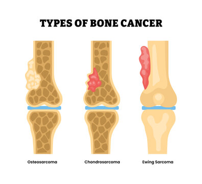 Different types of bone cancer types. Labeled osteosarcoma, chondrosarcoma, ewing sarcoma. Tumor cells with tissues mutation and inflammation. Flat vector illustration.