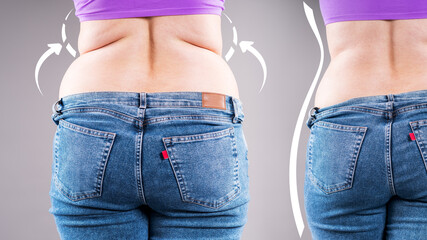Before after weight loss, woman's back fat and muffin top reduction, concept of liposuction, diet progress and body contouring © staras