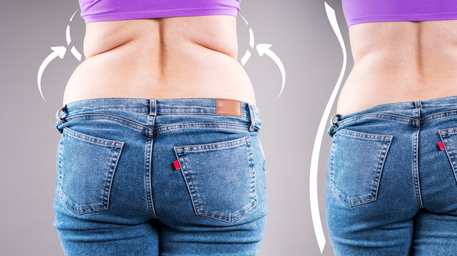 Before after weight loss, woman's back fat and muffin top reduction, concept of liposuction, diet progress and body contouring