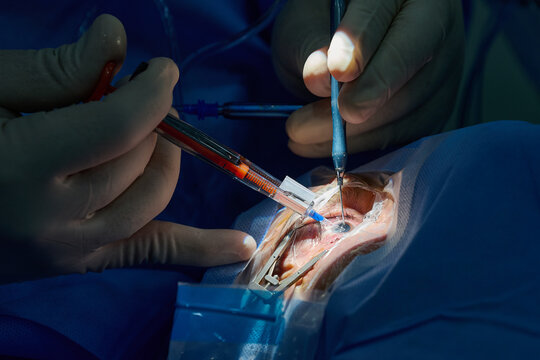 Ophthalmic surgeon performing cataract surgery with intraocular lens implantation, close-up of eye microsurgery in operating room.