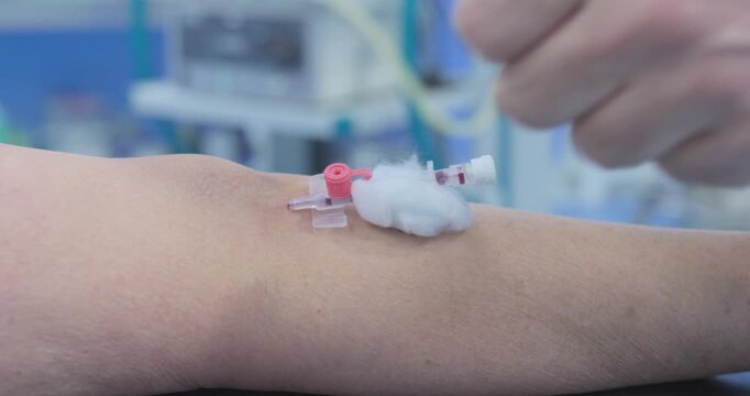 Close-up of a peripheral IV cannula inserted into a patient's arm with a protective cotton swab in a clinical setting
