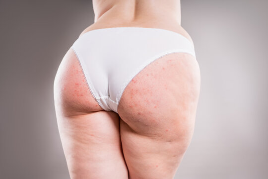 Female buttocks with red rash, bumps pimples. Folliculitis, keratosis pilaris, butt acne and dermatology skin problems