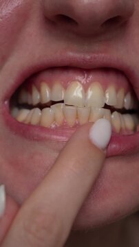 Close up of young woman showing teeth and touching gums. Visible dental problems such as irritation and uneven teeth. Concept of oral health, dental care and hygiene.