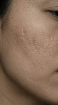 Extreme close up view person cheek showing acne scars large pores. Highlighting real skin texture imperfections dermatological awareness. Ideal skincare medical advertisements.