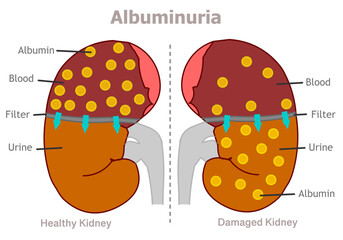 Albuminuria is a sign of kidney disease. Healthy kidneys prevent most of the albumin from passing through their filters and entering the urine.  Illustration vector © LuckySoul