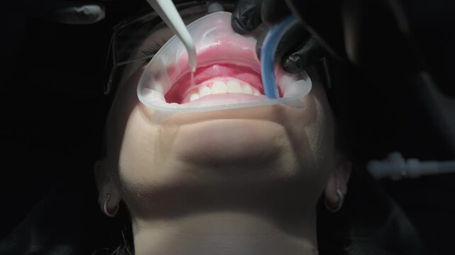 Low angle view of a female patient's mouth with a retractor during a professional teeth cleaning procedure, while the dentist uses a scaler and saliva ejector to remove tartar and plaque