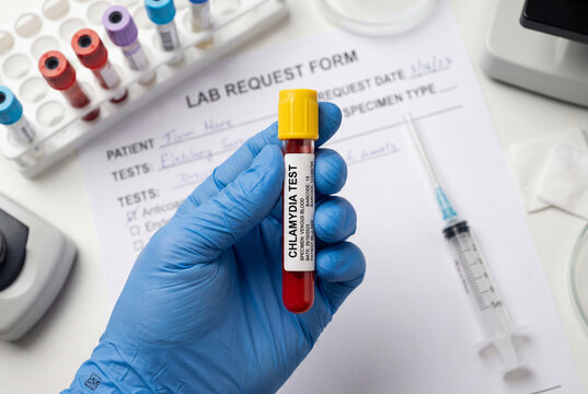 Gloved hand holding a blood sample tube labeled for chlamydia testing over a medical lab form