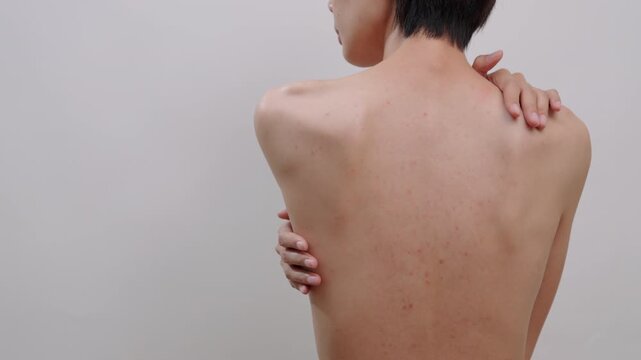 Close-up of asian female touching their shoulder, showing back acne, blemishes, and uneven skin tone. Ideal for dermatology, body skincare, and health concepts.