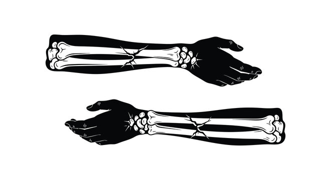 Broken arms with skeletal detail depicted as a dark silhouette