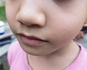 Fototapeta premium Upper lip sweat on a child face.