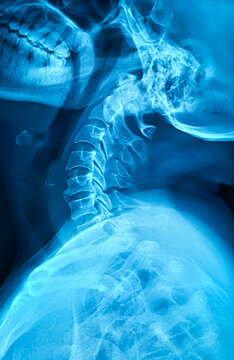 X-ray of human cervical spine. Cervical spondylosis. 