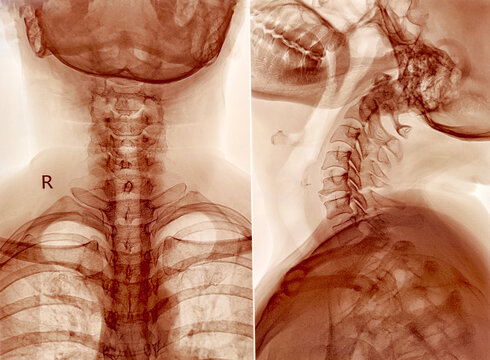 X-ray of human cervical spine. Cervical spondylosis. 