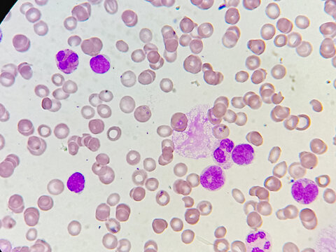 Acute Leukaemia. Acute leukemia on microscopic examination. acute leukemia.