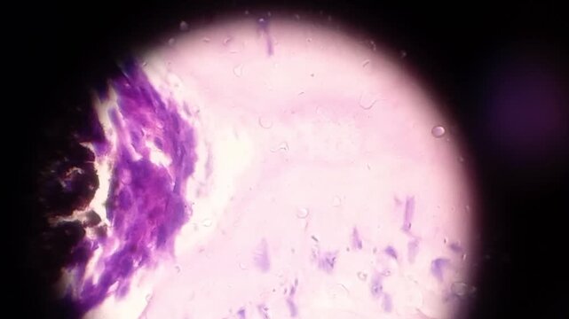 Tissue from left auricle. Carcinoma in situ with microinvasion. Histopathology microscopic footage.