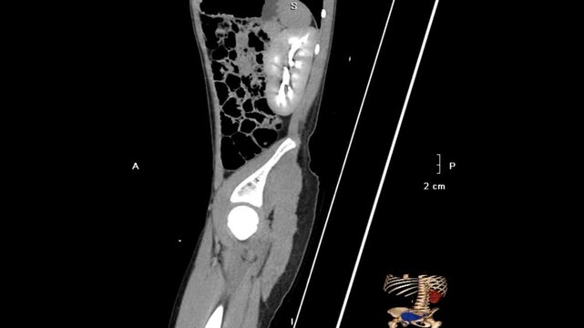 Multiplanar abdominal CT imaging in sagittal, coronal, and axial views demonstrating unilateral renal agenesis with absence of one kidney and compensatory contralateral renal anatomy.