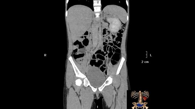 Multiplanar abdominal CT imaging in sagittal, coronal, and axial views demonstrating unilateral renal agenesis with absence of one kidney and compensatory contralateral renal anatomy.