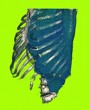3D CT thorax shows pleural effusion with fluid accumulation in the lung cavity. Generated from real CT imaging data for clinical evaluation, not AI-generated