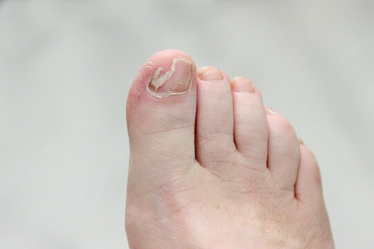 toe nail filed smooth in preparation for reconstruction