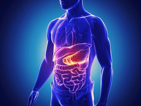 Medical illustration of pancreatic cancer, a highly aggressive malignant tumor originating in the pancreatic tissue, often diagnosed at advanced stages due to subtle early symptoms