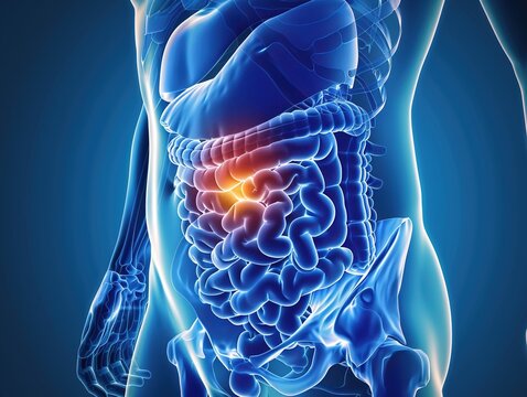 Medical illustration of pancreatic cancer, a highly aggressive malignant tumor originating in the pancreatic tissue, often diagnosed at advanced stages due to subtle early symptoms
