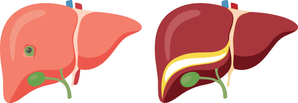 Liver anatomy illustration comparing healthy liver and diseased liver with bile duct and gallbladder details in clean medical flat vector style