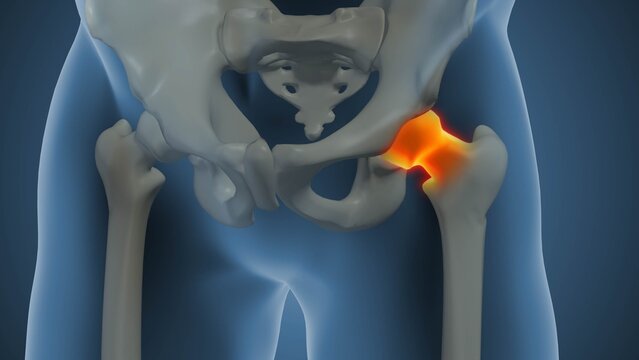 Pain due to Avascular Necrosis of the Hip