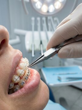 Dentist Adjusting Dental Braces on Patient's Teeth