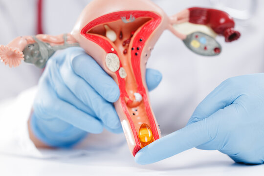 Closeup gynecologist demonstration of an vitamins pill and suppositories to restore microflora and uterine anatomy model for patient medical health