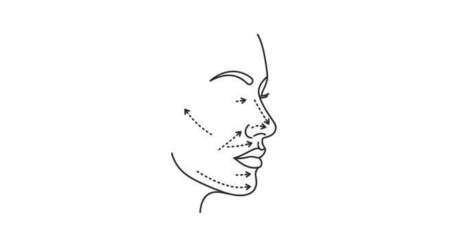 Facial lines and arrows indicating cosmetic surgery or treatment areas on a profile view