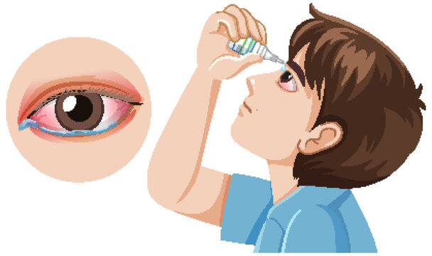 Boy Using Eye Drops for Red Irritated Eye