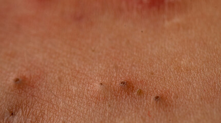 Fototapeta premium Acne close up skin problem with pimple and pores texture detail. Close up pimple in acne shows sebum, comedone, and whitehead. Acne close up with rash, papules, and blemish on skin.