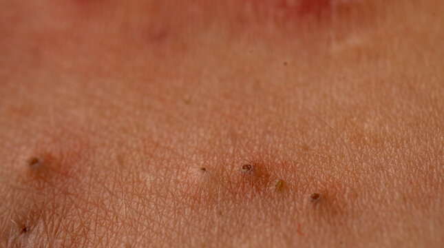 Acne close up skin problem with pimple and pores texture detail. Close up pimple in acne shows sebum, comedone, and whitehead. Acne close up with rash, papules, and blemish on skin.